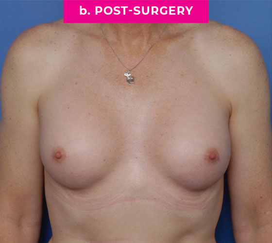 Gender Confirmation Breast Aug Patient 6 After