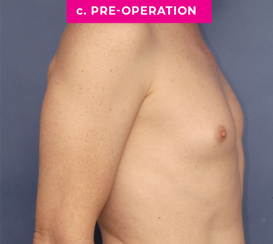 Gender Confirmation Breast Aug Patient 6 Before Side