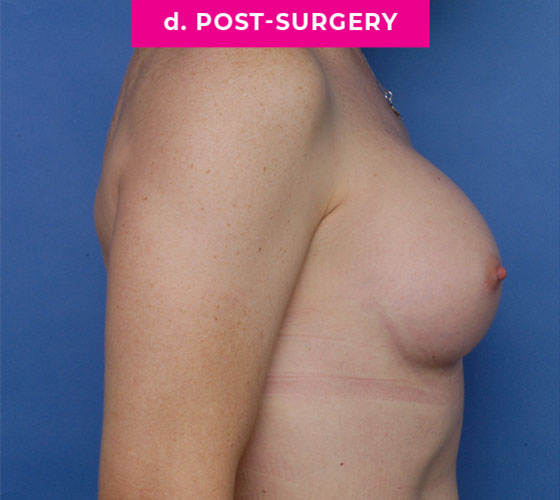 Gender Confirmation Breast Aug Patient 6 After Side