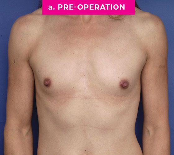 Gender Confirmation Breast Aug Patient 7 Before