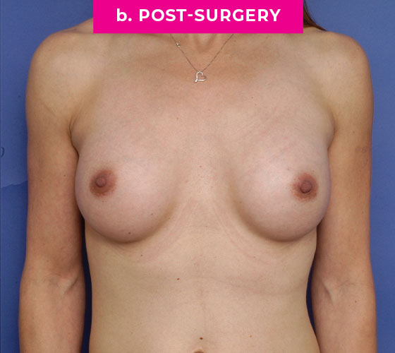 Gender Confirmation Breast Aug Patient 7 After