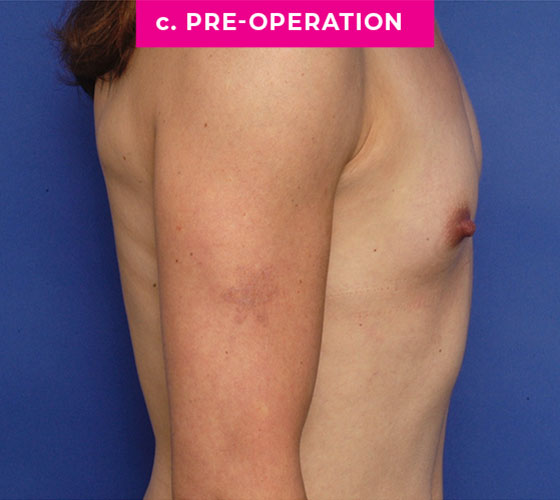 Gender Confirmation Breast Aug Patient 7 Before Side