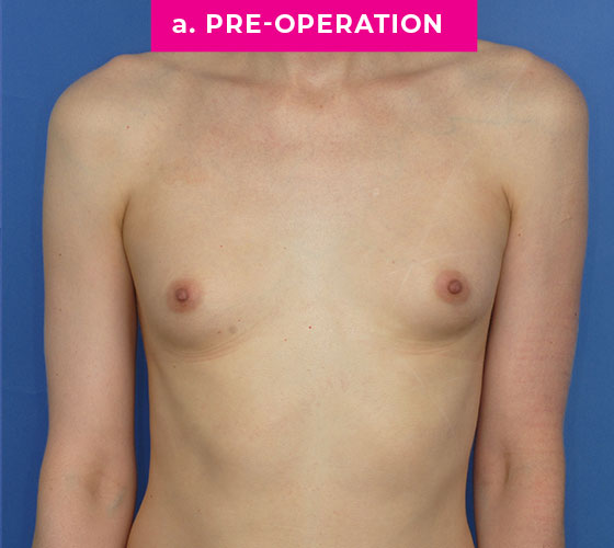 Gender Confirmation Breast Aug Patient 8 Before