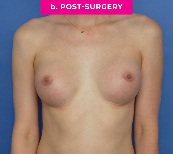 Gender Confirmation Breast Aug Patient 8 After