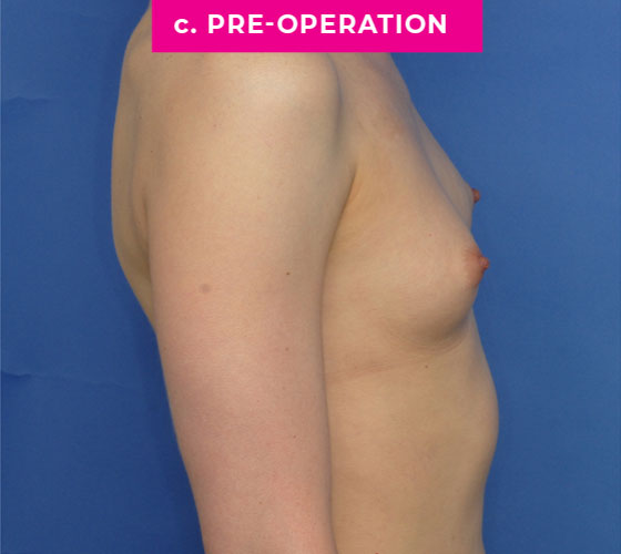 Gender Confirmation Breast Aug Patient 8 Before Side