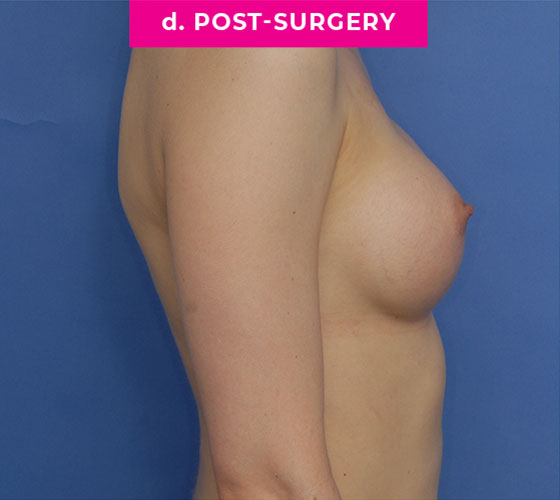 Gender Confirmation Breast Aug Patient 8 After Side