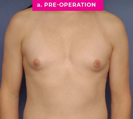 Gender Confirmation Breast Aug Patient 9 Before