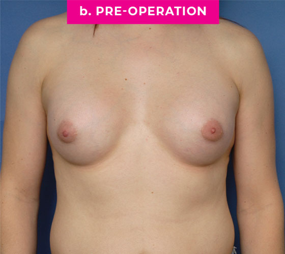 Gender Confirmation Breast Aug Patient 9 After