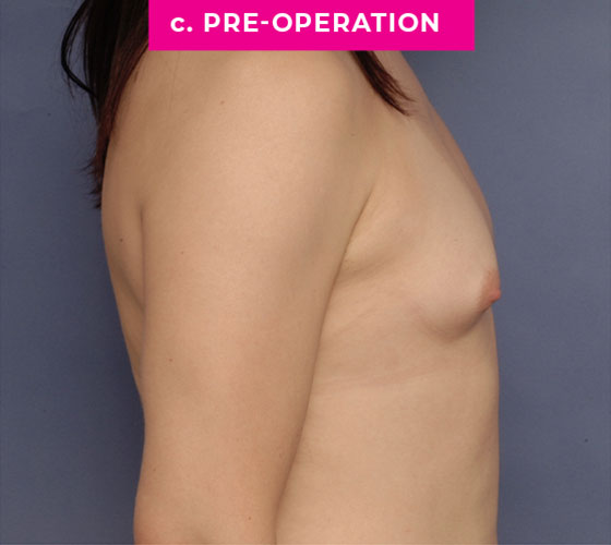 Gender Confirmation Breast Aug Patient 9 Before Side