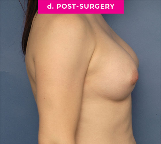 Gender Confirmation Breast Aug Patient 9 After Side