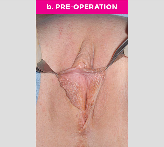Clitoris Reduction Patient 1 Before 2