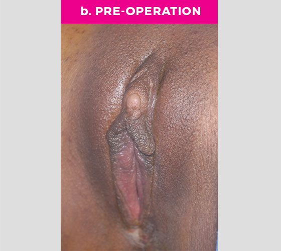 Clitoris Reduction Patient 11 Before 2