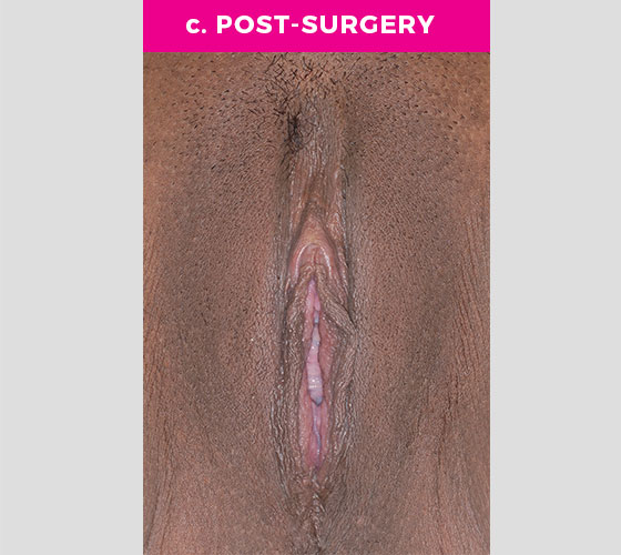 Clitoris Reduction Patient 11 After