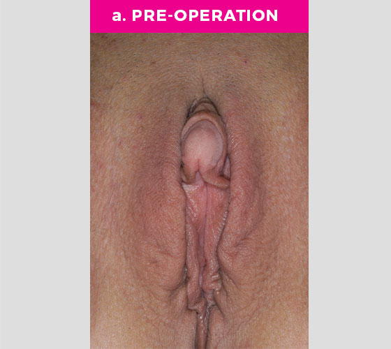 Clitoris Reduction Patient 13 Before