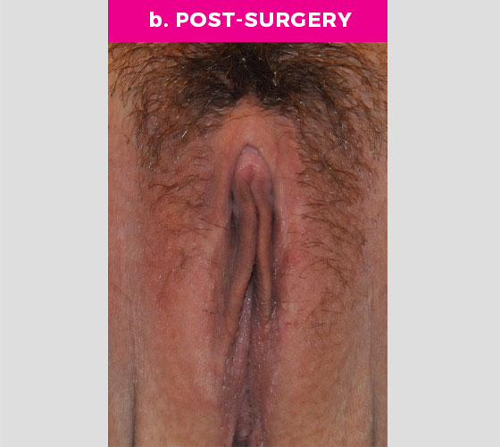 Clitoris Reduction Patient 13 After