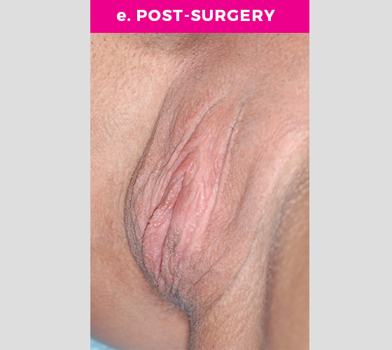 Clitoris Reduction Patient 14 After 2