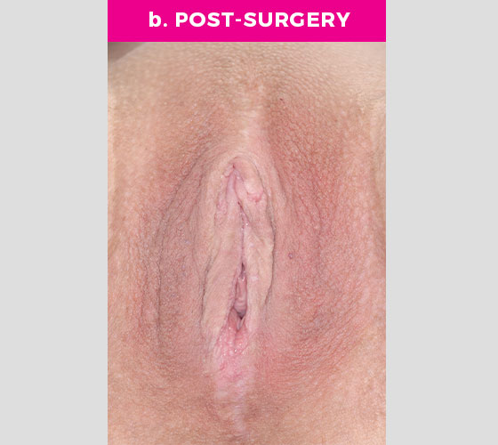 Clitoris Reduction Patient 17 After