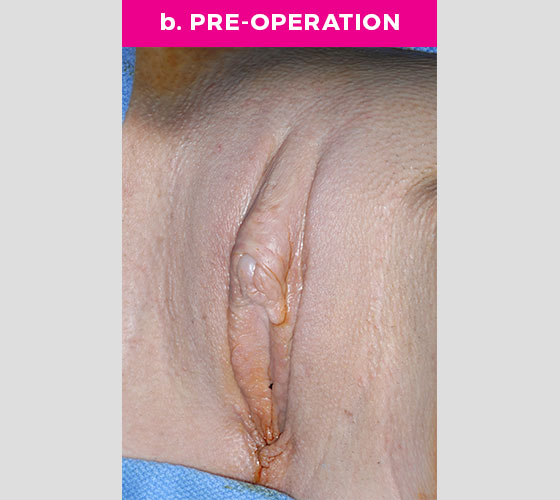 Clitoris Reduction Patient 2 Before