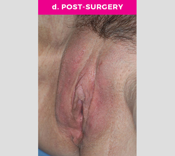 Clitoris Reduction Patient 3 After 2