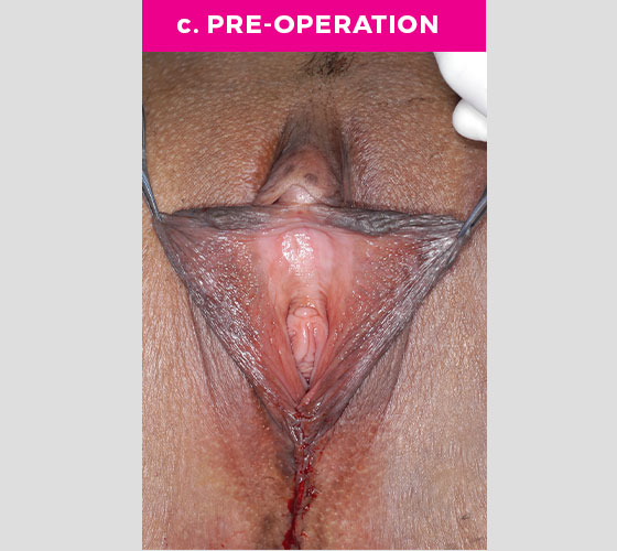 Clitoris Reduction Patient 4 Before 3