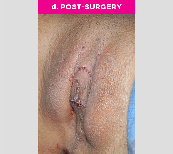 Clitoris Reduction Patient 6 After 2