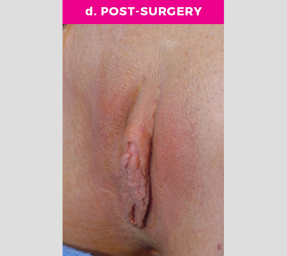 Clitoris Reduction Patient 7 After 2