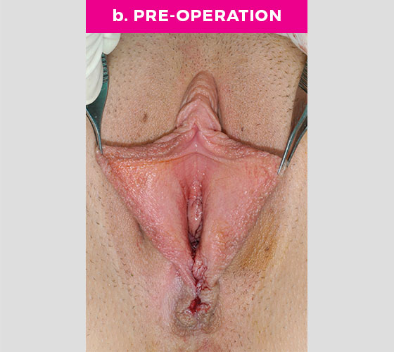 Clitoris Reduction Patient 8 Before 2