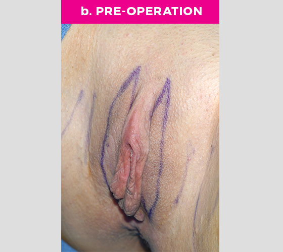 Clitoris Reduction Patient 9 Before 2