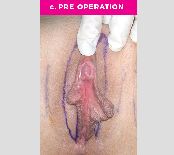 Clitoris Reduction Patient 9 Before 3