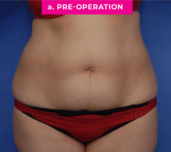 Abdominoplasty Patient 1 Before