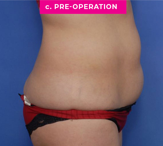 Abdominoplasty Patient 1 Before Side