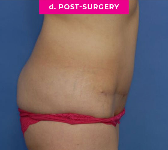 Abdominoplasty Patient 1 After Side