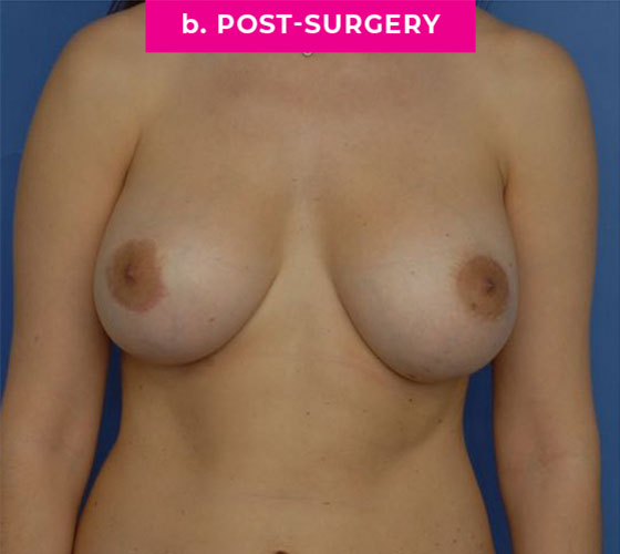 Breast Reconstruction Patient 1 After