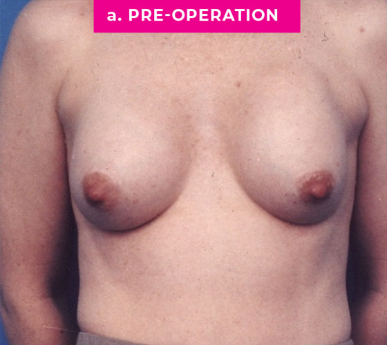 Breast Reconstruction Patient 2 Before