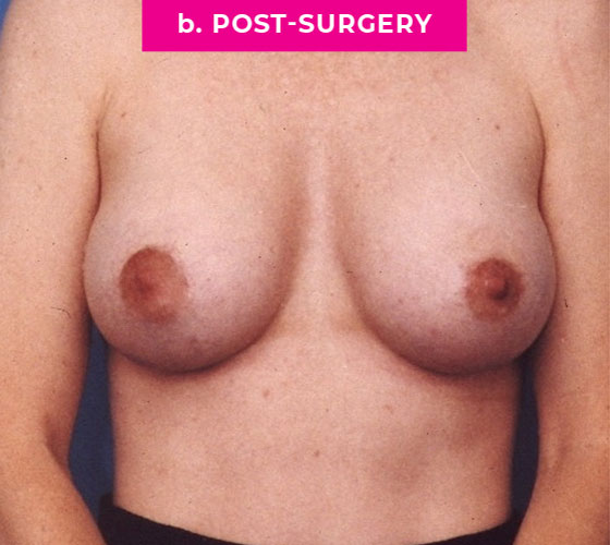 Breast Reconstruction Patient 2 After