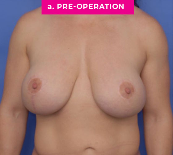 Breast Reconstruction Patient 3 Before