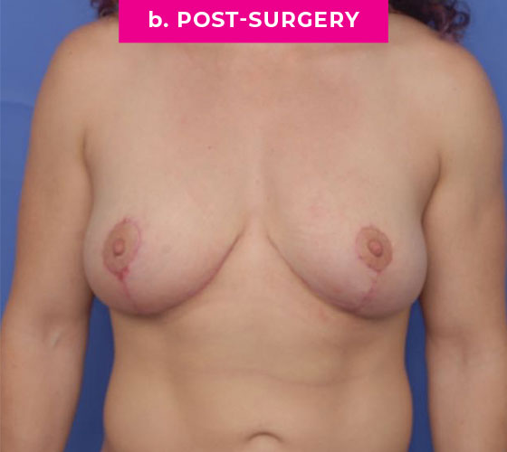 Breast Reconstruction Patient 3 After