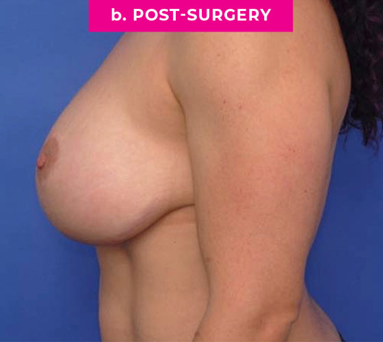 Breast Reconstruction Patient 3 After Side