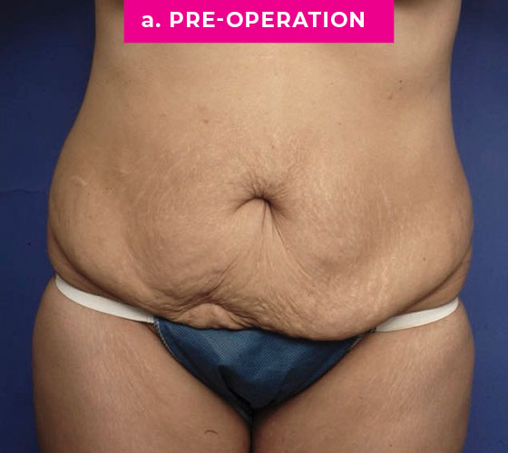 Abdominoplasty Patient 4 Before