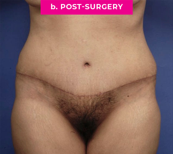 Abdominoplasty Patient 4 After