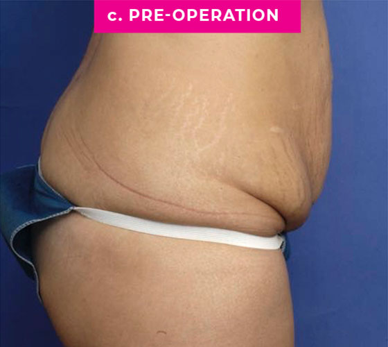 Abdominoplasty Patient 4 Before Side