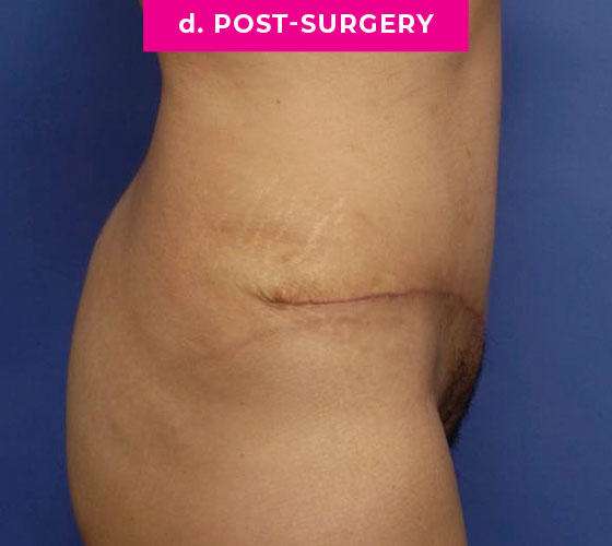 Abdominoplasty Patient 4 After Side