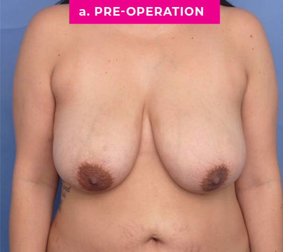 Breast Reconstruction Patient 4 Before