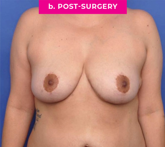 Breast Reconstruction Patient 4 After