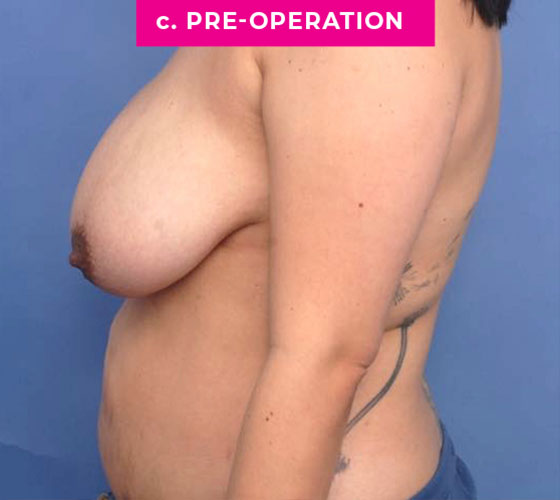 Breast Reconstruction Patient 4 Before Side