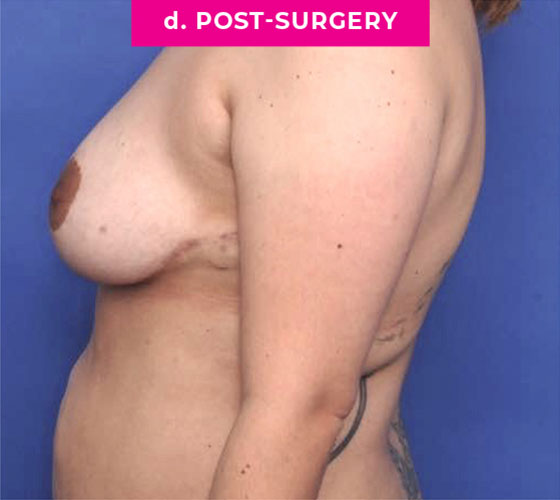 Breast Reconstruction Patient 4 After Side