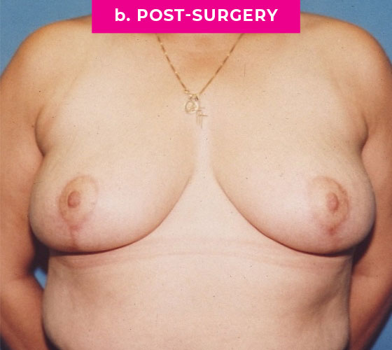 Breast Reconstruction Patient 5 After