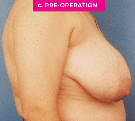 Breast Reconstruction Patient 5 Before Side