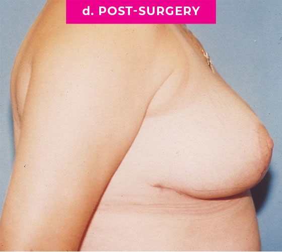 Breast Reconstruction Patient 5 After Side