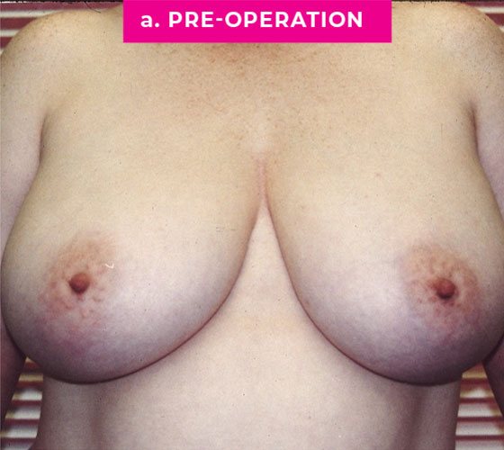 Breast Reconstruction Patient 6 Before
